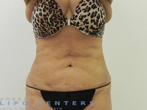 americanlipocenters_34.jpg